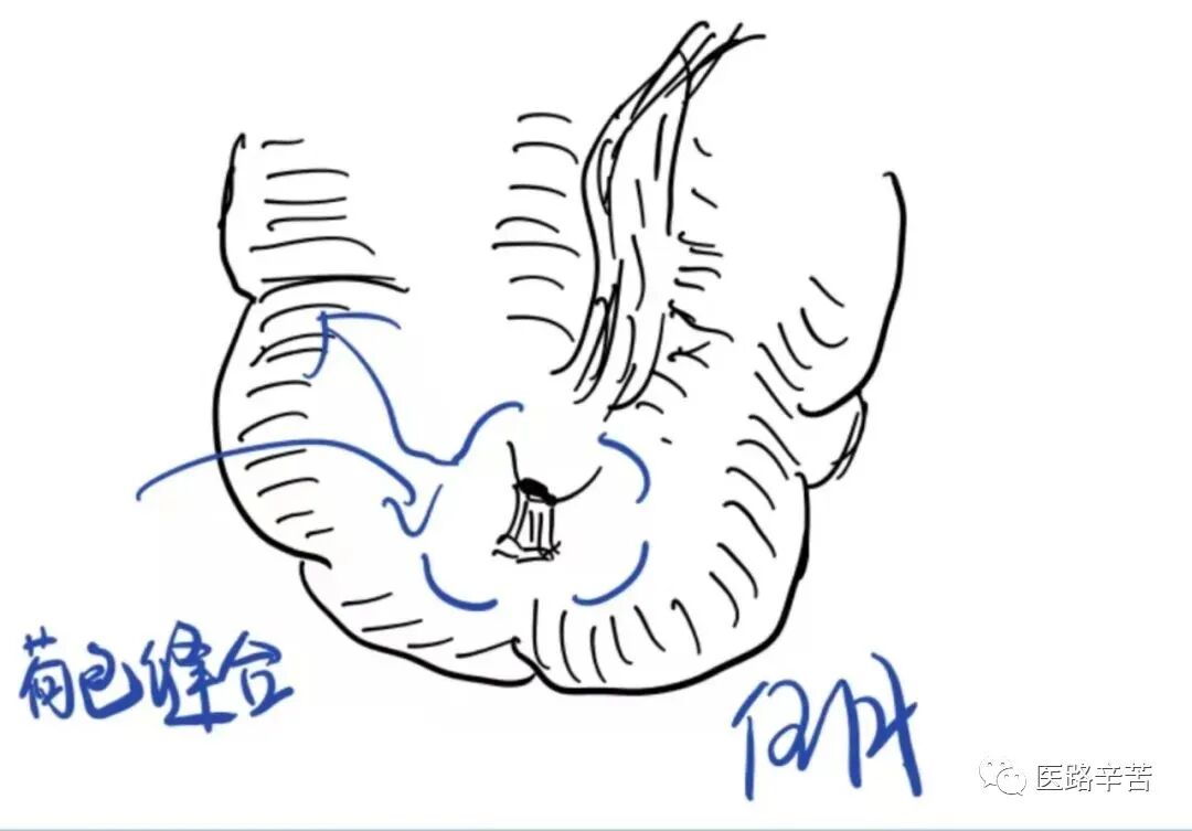 缝合线怎么消毒关于急诊清创缝合术必须掌握的知识_https://www.jmylbn.com_新闻资讯_第19张