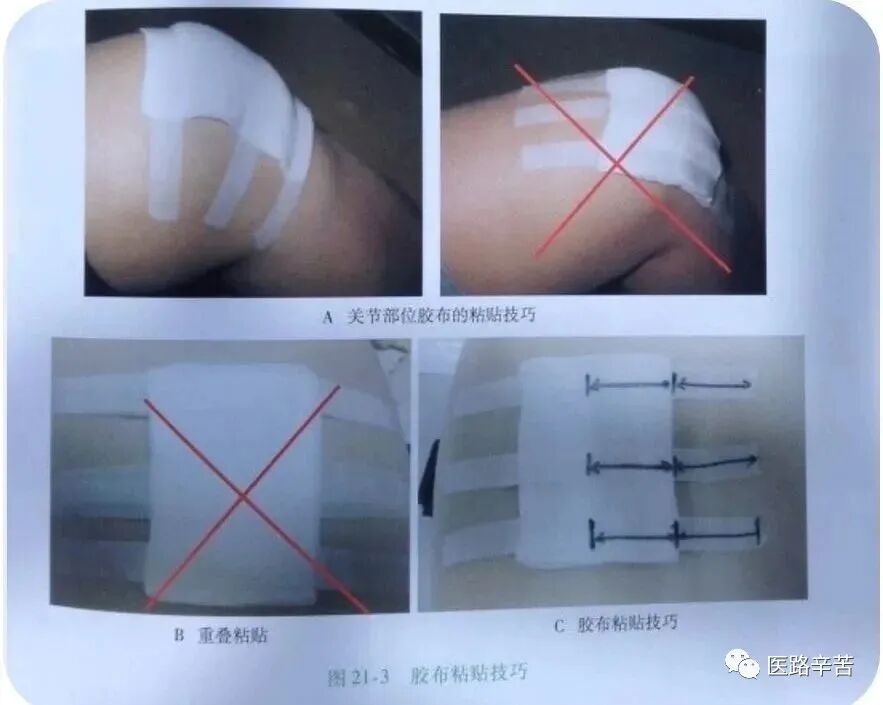 伤口贴敷料为什么伤口敷料的分类与选择技巧_https://www.jmylbn.com_新闻资讯_第23张