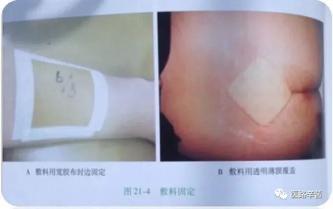 伤口贴敷料为什么伤口敷料的分类与选择技巧_https://www.jmylbn.com_新闻资讯_第27张
