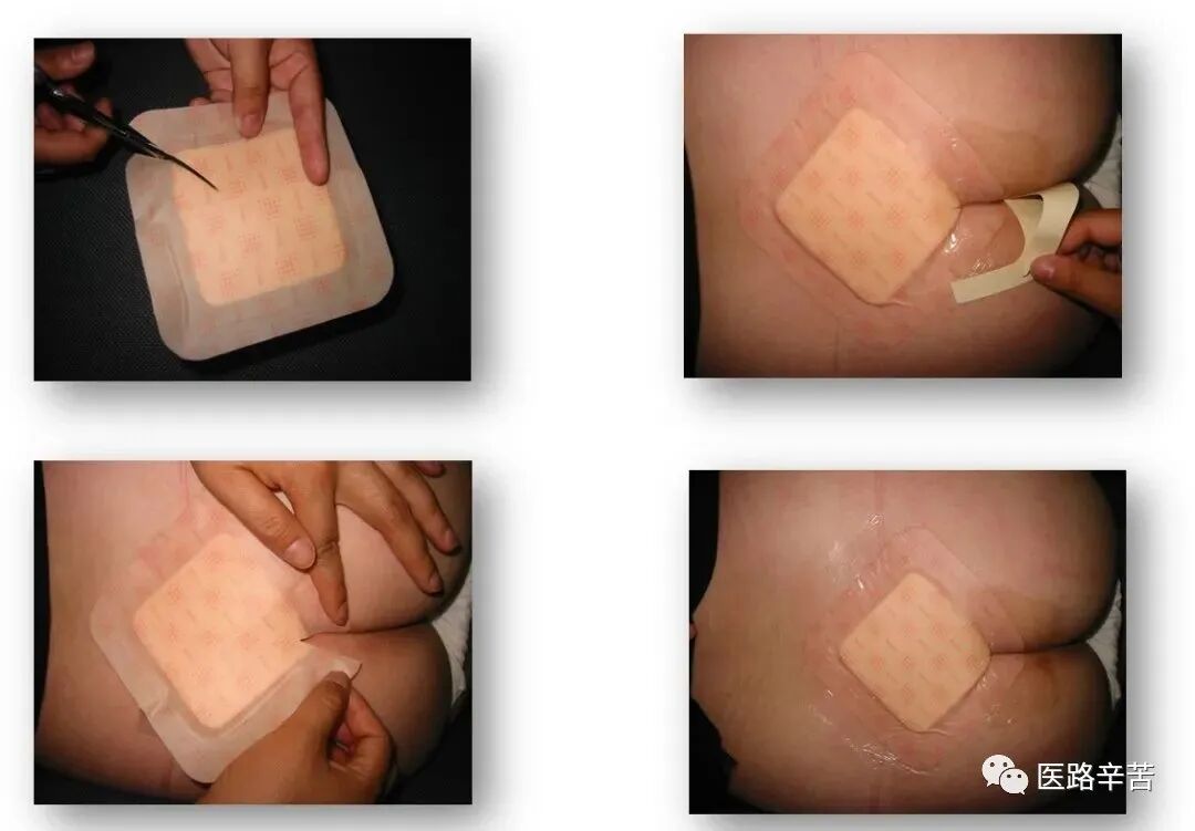 伤口贴敷料为什么伤口敷料的分类与选择技巧_https://www.jmylbn.com_新闻资讯_第13张