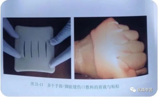 伤口贴敷料为什么伤口敷料的分类与选择技巧_https://www.jmylbn.com_新闻资讯_第25张