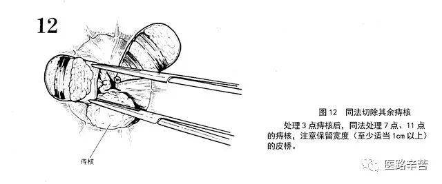 痔手术图解 | 混合痔外剥内扎术