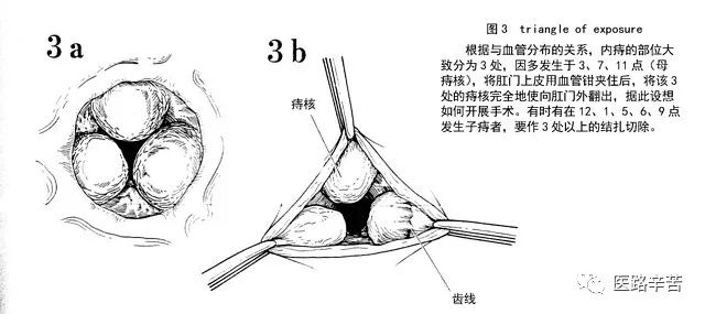 痔手术图解 | 混合痔外剥内扎术