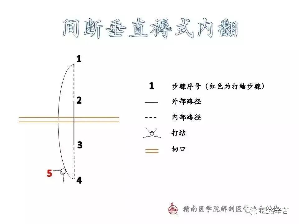 04 间断垂直褥式内翻03 连续锁边缝合02 单纯连续缝合