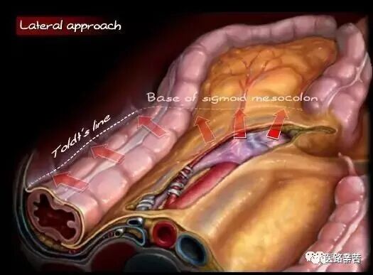腹腔镜下乙状结肠切除术