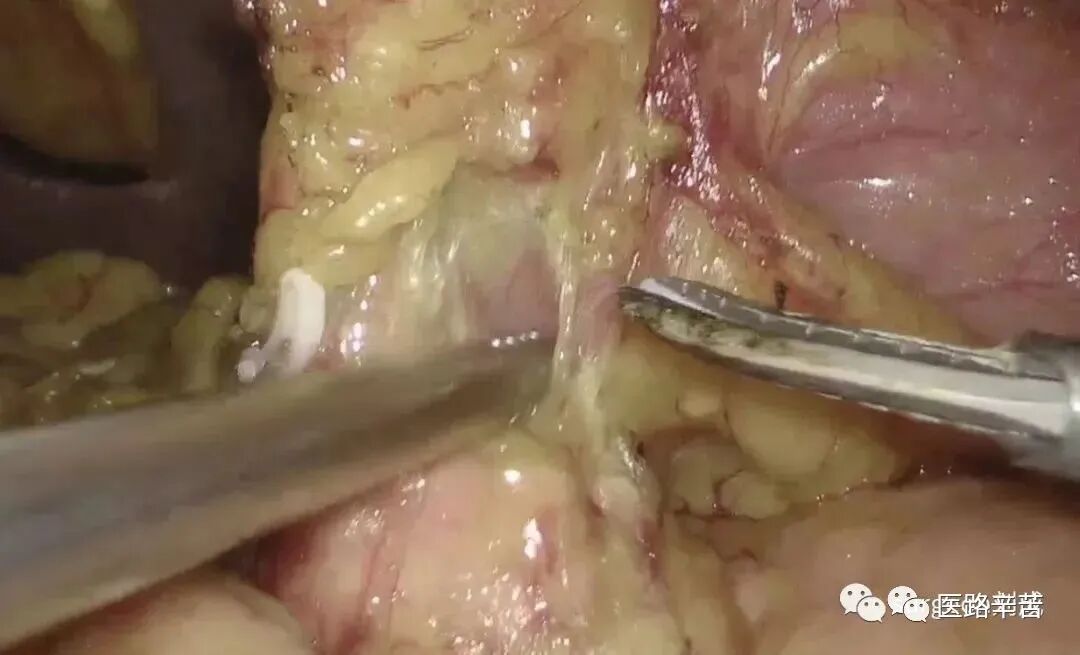 手术吸引器怎么使用腹腔镜器械 ｜ 吸引器的“妙用”_https://www.jmylbn.com_新闻资讯_第21张