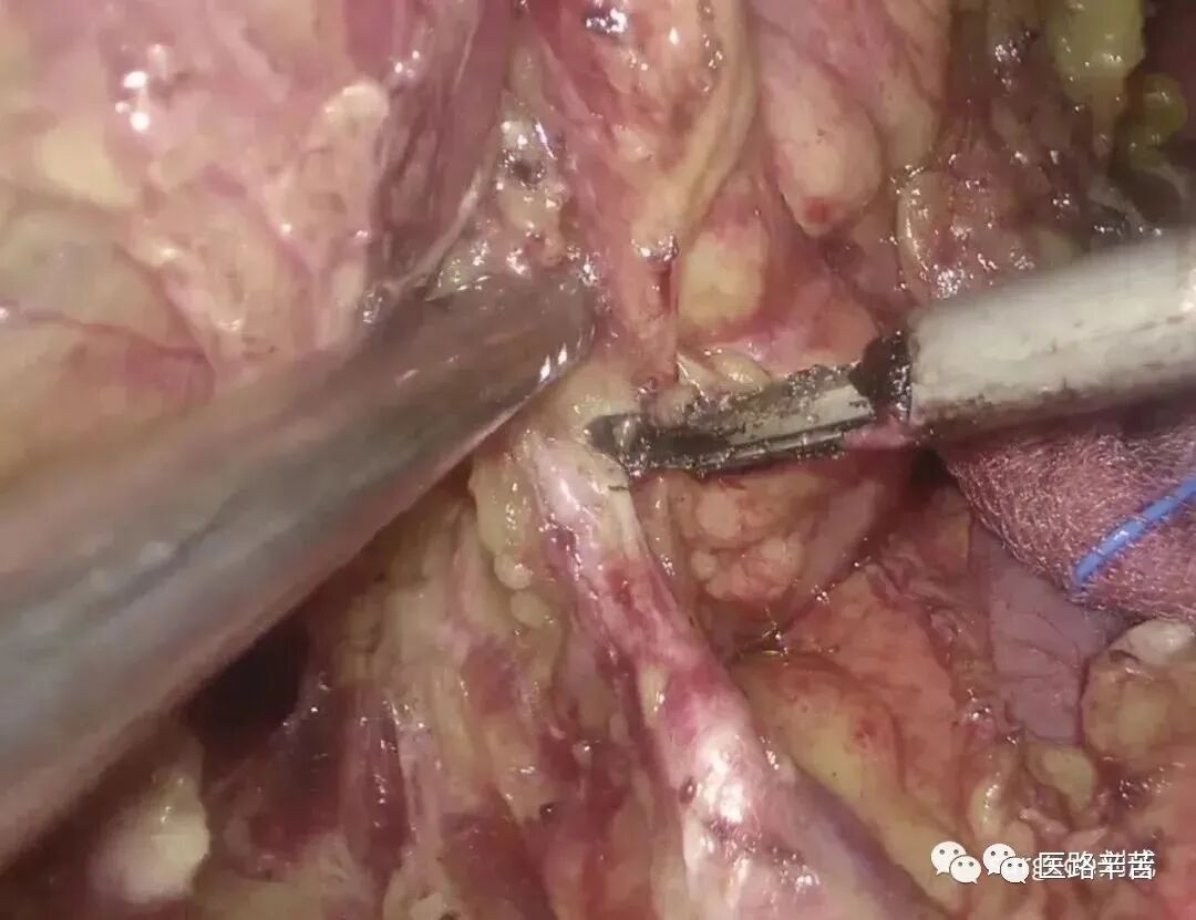 手术吸引器怎么使用腹腔镜器械 ｜ 吸引器的“妙用”_https://www.jmylbn.com_新闻资讯_第22张