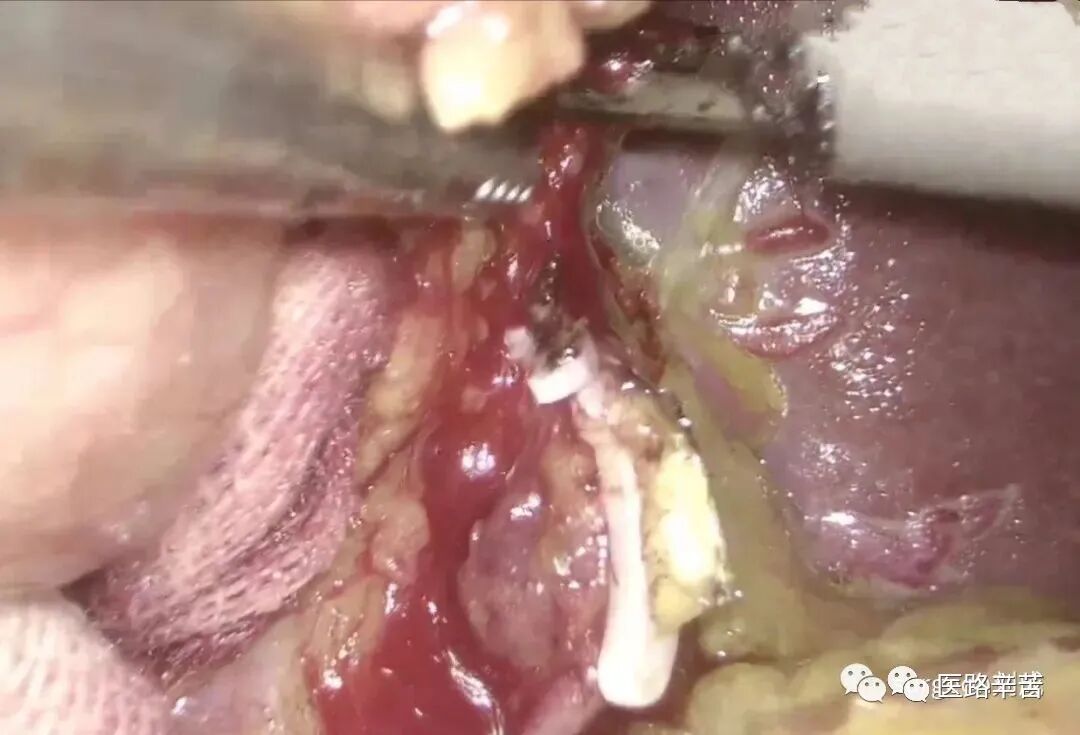 手术吸引器怎么使用腹腔镜器械 ｜ 吸引器的“妙用”_https://www.jmylbn.com_新闻资讯_第8张