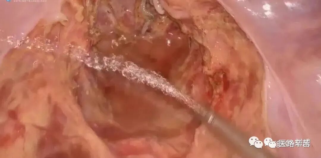 手术吸引器怎么使用腹腔镜器械 ｜ 吸引器的“妙用”_https://www.jmylbn.com_新闻资讯_第5张