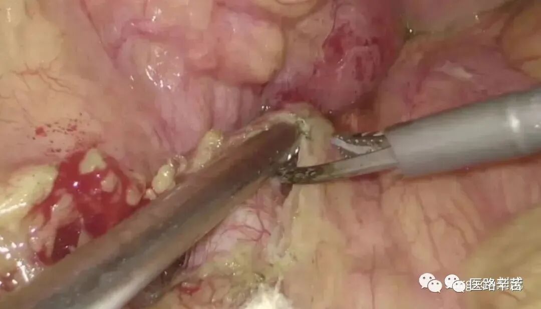 手术吸引器怎么使用腹腔镜器械 ｜ 吸引器的“妙用”_https://www.jmylbn.com_新闻资讯_第16张