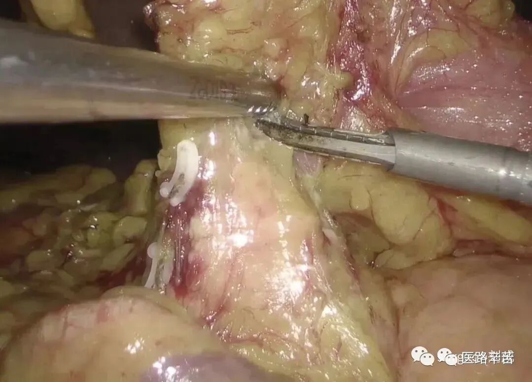 手术吸引器怎么使用腹腔镜器械 ｜ 吸引器的“妙用”_https://www.jmylbn.com_新闻资讯_第12张