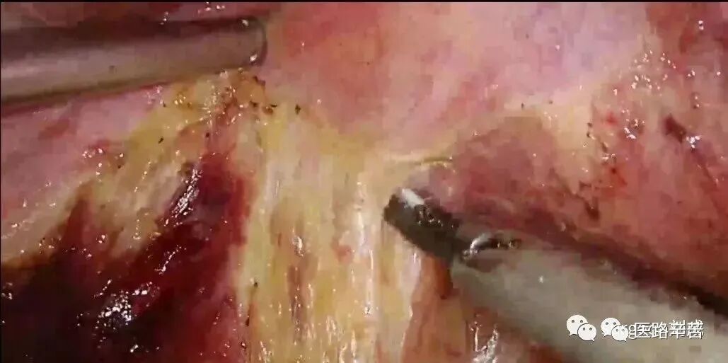 手术吸引器怎么使用腹腔镜器械 ｜ 吸引器的“妙用”_https://www.jmylbn.com_新闻资讯_第14张