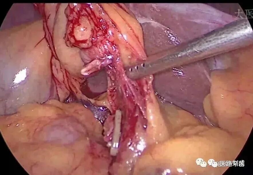 手术吸引器怎么使用腹腔镜器械 ｜ 吸引器的“妙用”_https://www.jmylbn.com_新闻资讯_第19张