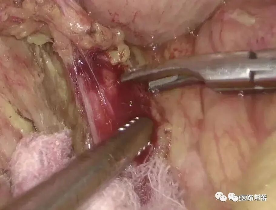 手术吸引器怎么使用腹腔镜器械 ｜ 吸引器的“妙用”_https://www.jmylbn.com_新闻资讯_第10张