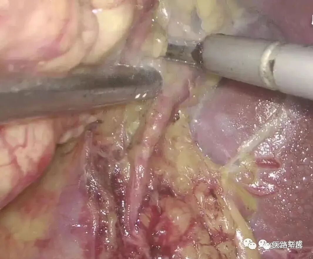 手术吸引器怎么使用腹腔镜器械 ｜ 吸引器的“妙用”_https://www.jmylbn.com_新闻资讯_第6张