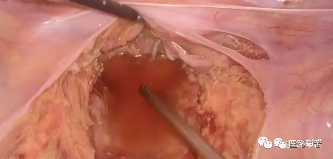 手术吸引器怎么使用腹腔镜器械 ｜ 吸引器的“妙用”_https://www.jmylbn.com_新闻资讯_第4张