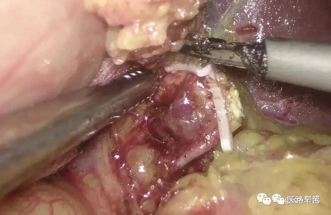 手术吸引器怎么使用腹腔镜器械 ｜ 吸引器的“妙用”_https://www.jmylbn.com_新闻资讯_第11张