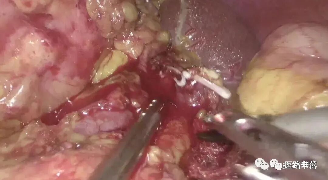 手术吸引器怎么使用腹腔镜器械 ｜ 吸引器的“妙用”_https://www.jmylbn.com_新闻资讯_第7张