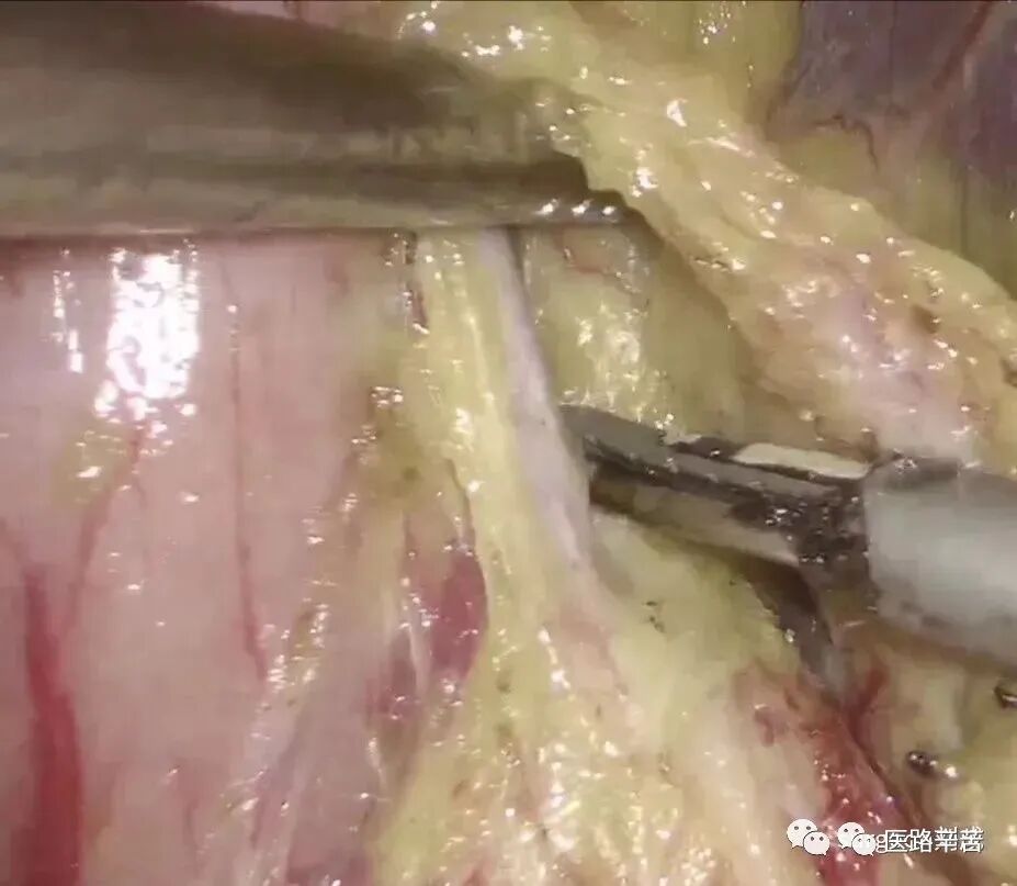 手术吸引器怎么使用腹腔镜器械 ｜ 吸引器的“妙用”_https://www.jmylbn.com_新闻资讯_第20张