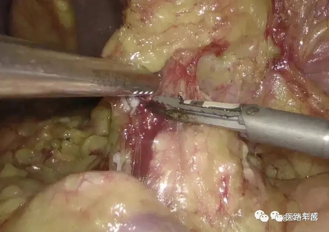 手术吸引器怎么使用腹腔镜器械 ｜ 吸引器的“妙用”_https://www.jmylbn.com_新闻资讯_第9张