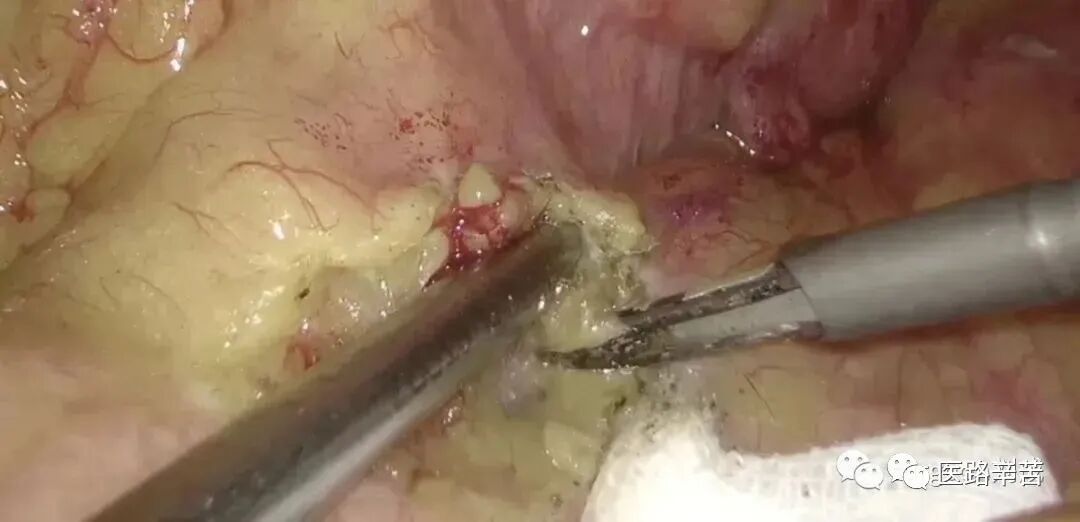 手术吸引器怎么使用腹腔镜器械 ｜ 吸引器的“妙用”_https://www.jmylbn.com_新闻资讯_第15张