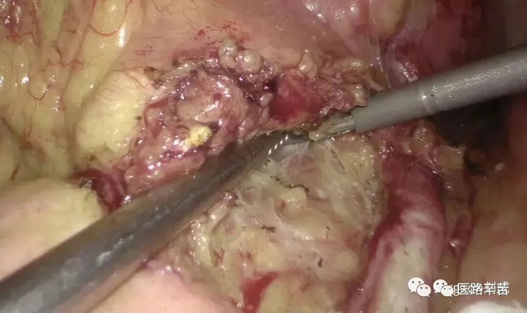 手术吸引器怎么使用腹腔镜器械 ｜ 吸引器的“妙用”_https://www.jmylbn.com_新闻资讯_第17张