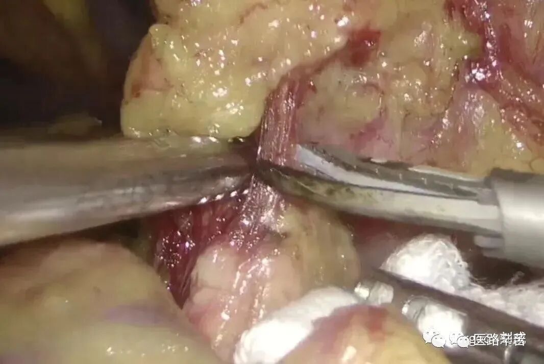 手术吸引器怎么使用腹腔镜器械 ｜ 吸引器的“妙用”_https://www.jmylbn.com_新闻资讯_第13张