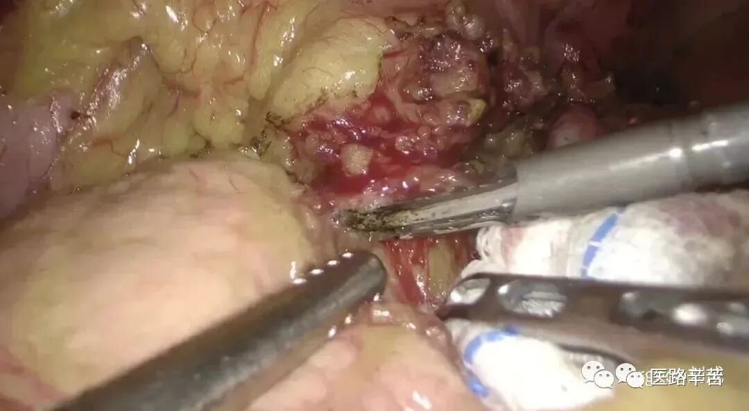 手术吸引器怎么使用腹腔镜器械 ｜ 吸引器的“妙用”_https://www.jmylbn.com_新闻资讯_第18张