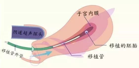 提升試管成功率，醫學上有什麼前沿的辦法？ 健康 第3張