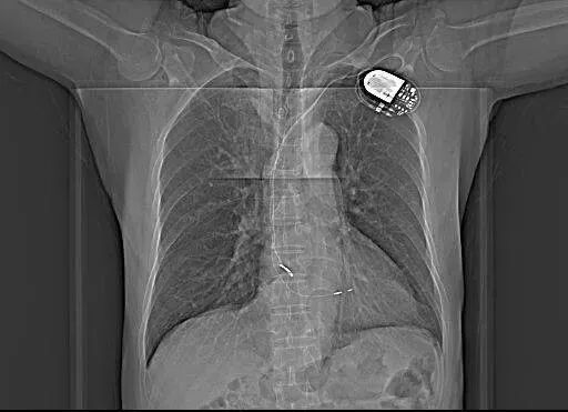 心电图器怎么用双腔起搏器最常见的2种工作方式及BFS_https://www.jmylbn.com_新闻资讯_第10张