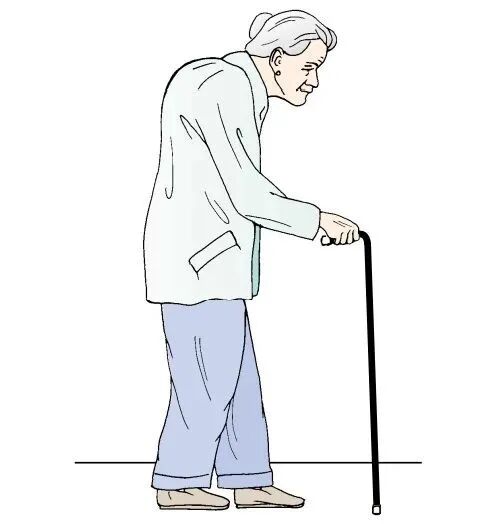 年纪大了变矮了?驼背?