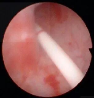 输尿管镜需要哪些导丝手把手教你玩转输尿管镜_https://www.jmylbn.com_新闻资讯_第3张