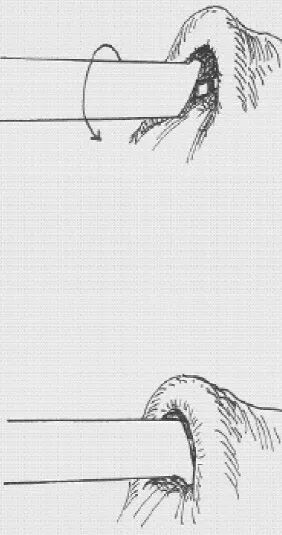 输尿管镜需要哪些导丝手把手教你玩转输尿管镜_https://www.jmylbn.com_新闻资讯_第2张