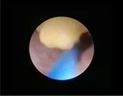 什么是输尿管镜​镜中天地：一带一路输尿管_https://www.jmylbn.com_新闻资讯_第3张