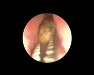 什么是输尿管镜​镜中天地：一带一路输尿管_https://www.jmylbn.com_新闻资讯_第6张