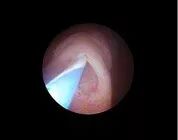 什么是输尿管镜​镜中天地：一带一路输尿管_https://www.jmylbn.com_新闻资讯_第2张