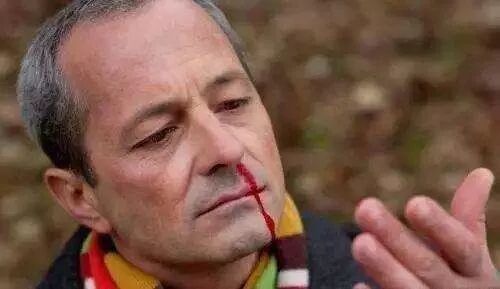 鼻腔问题系列：鼻子出血不一定只是上火了，还可能是大病！