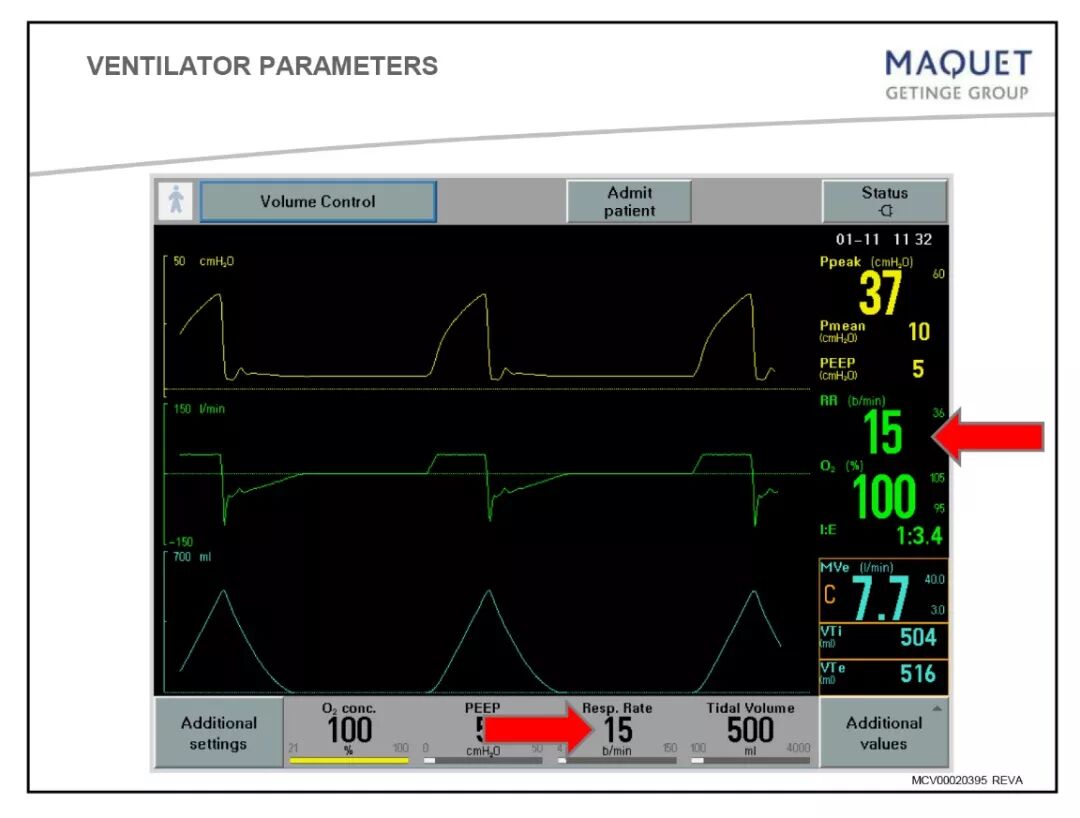 呼吸机呼吸怎么写呼吸机使用指南：让护士碰到呼吸机参数不再慌！_https://www.jmylbn.com_新闻资讯_第3张