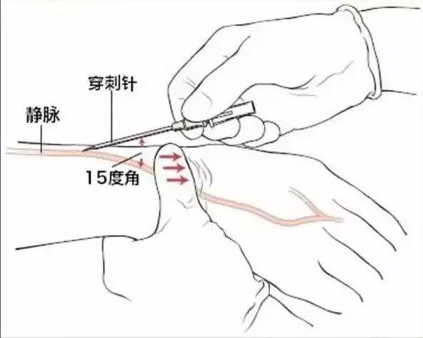 静脉的注射部位及角度图片