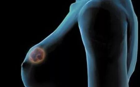 女性斑秃警惕乳腺癌可能