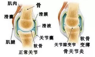 關節炎治療，不妨試試醫用三氧療法 健康 第3張