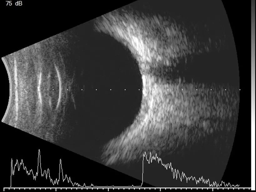 眼科a超怎么做眼部A型超声与眼部B型超声区别（专业篇）_https://www.jmylbn.com_新闻资讯_第7张