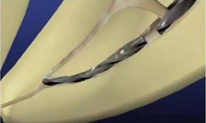 为什么要用根管马达【牙医必备】机扩使用说明、注意事项大全！_https://www.jmylbn.com_新闻资讯_第5张