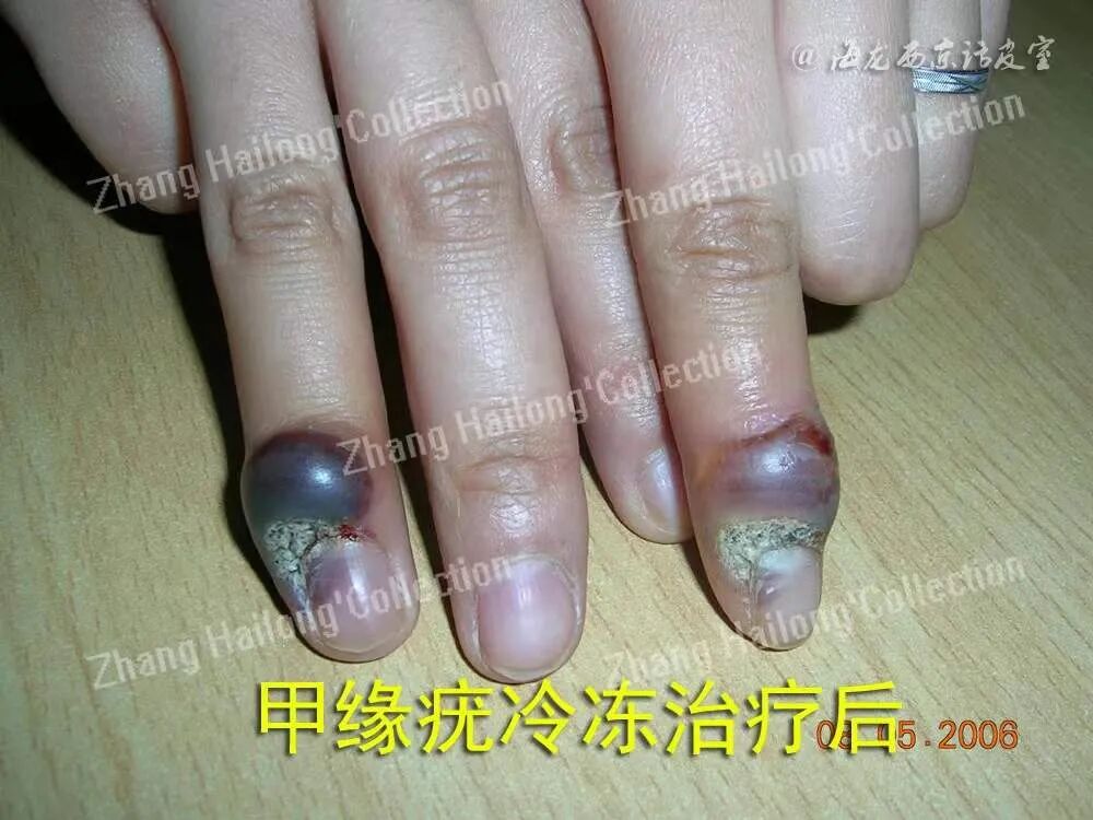 双极电凝是什么一文读懂：皮肤科物理治疗_https://www.jmylbn.com_新闻资讯_第2张