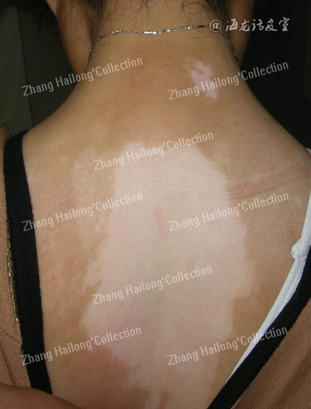 什么是窄谱紫外线治疗紫外线治疗皮肤病临床应用专家共识_https://www.jmylbn.com_新闻资讯_第9张