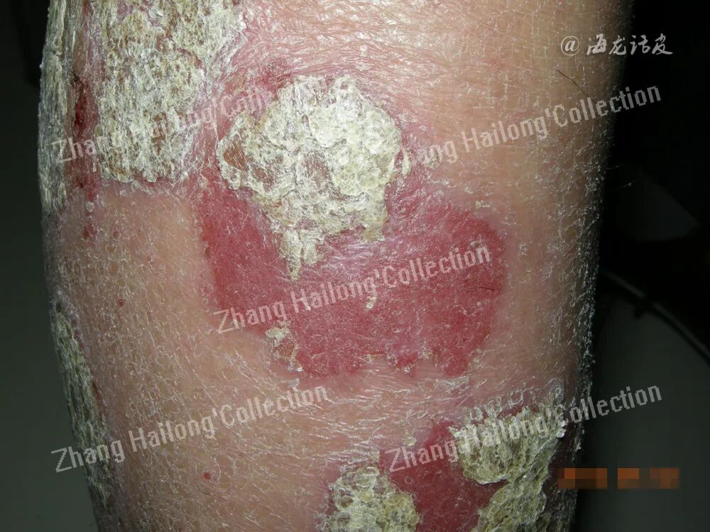 什么是窄谱紫外线治疗紫外线治疗皮肤病临床应用专家共识_https://www.jmylbn.com_新闻资讯_第12张