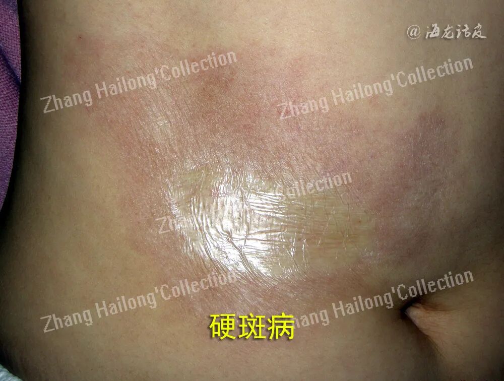 什么是窄谱紫外线治疗紫外线治疗皮肤病临床应用专家共识_https://www.jmylbn.com_新闻资讯_第13张