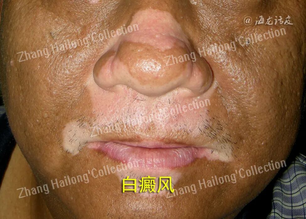 什么是窄谱紫外线治疗紫外线治疗皮肤病临床应用专家共识_https://www.jmylbn.com_新闻资讯_第8张