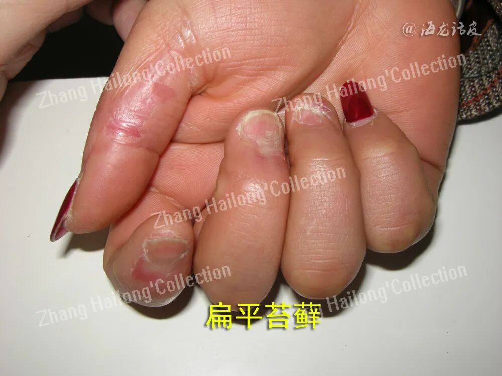 什么是窄谱紫外线治疗紫外线治疗皮肤病临床应用专家共识_https://www.jmylbn.com_新闻资讯_第15张