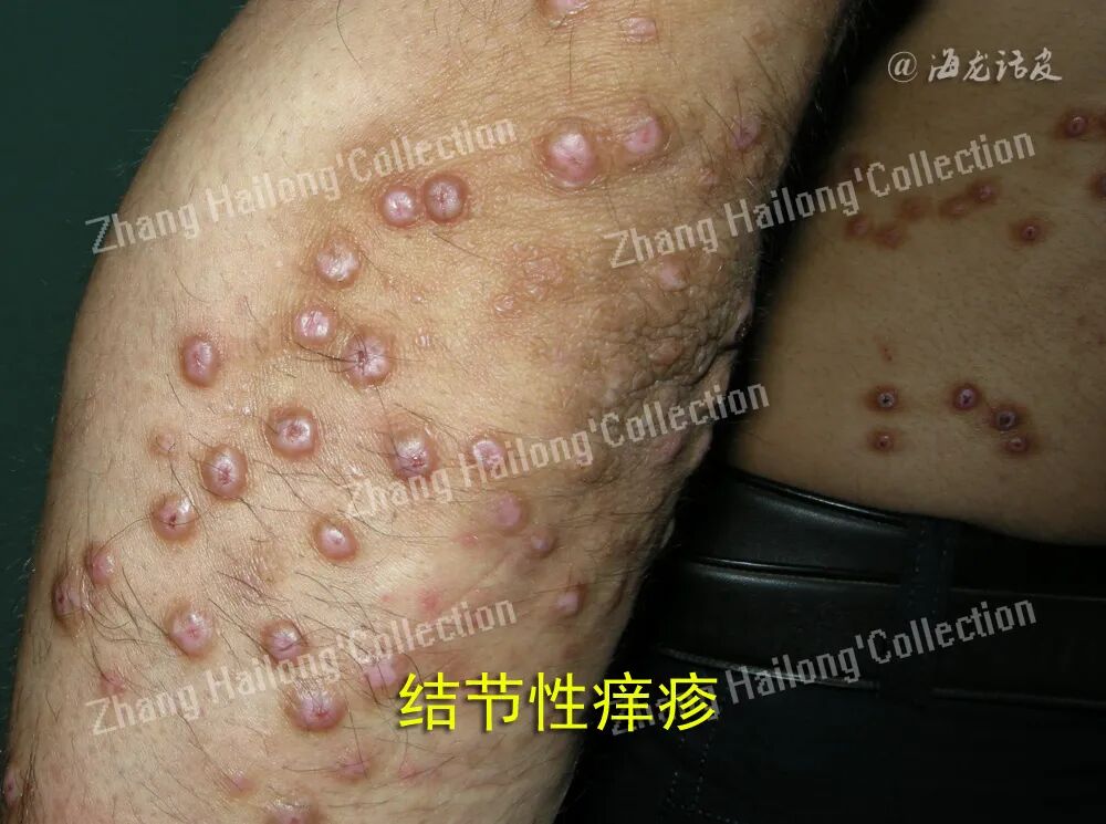 什么是窄谱紫外线治疗紫外线治疗皮肤病临床应用专家共识_https://www.jmylbn.com_新闻资讯_第4张